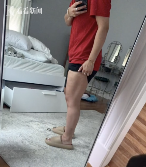动感单车骑太猛 美国女子横纹肌溶解险截肢