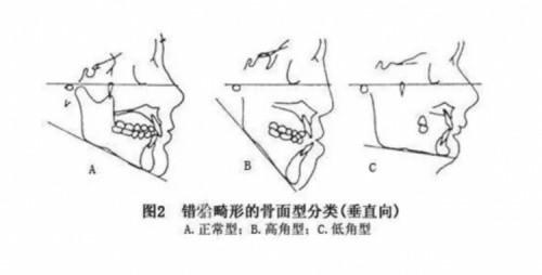 福斯曼foursmile一文教你笑線,下頜逆旋,正畸改善骨性嘴凸方法!