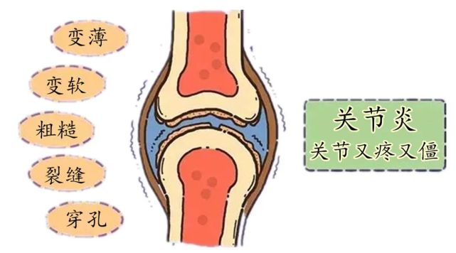 天冷不穿秋褲膝蓋疼,不穿秋褲會得關節炎嗎