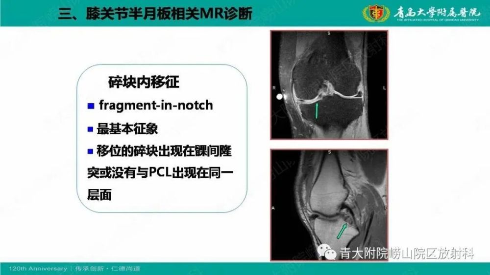 膝關節半月板及常見韌帶損傷的磁共振診斷