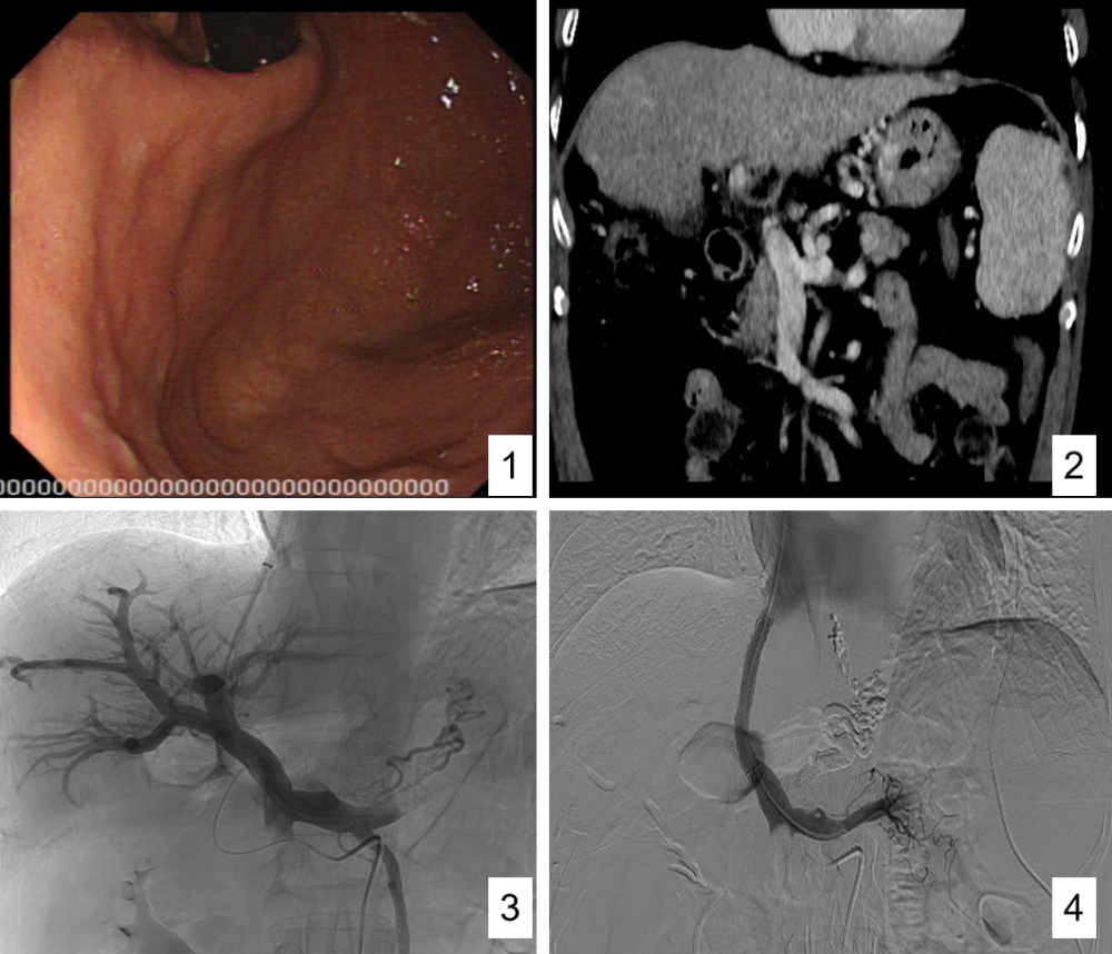 病例1(tipss 胃-食管曲张静脉栓塞术)46岁男性患者,因"突发呕血600ml"