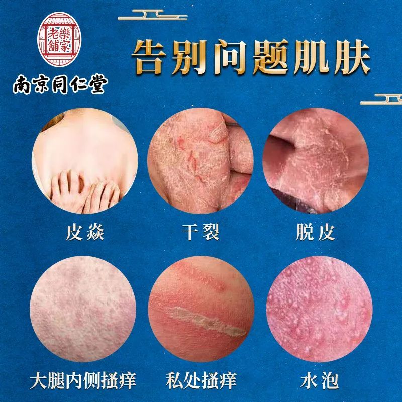 皮炎湿疹越挠越痒用它喷一喷3s止痒去疹除根不复发