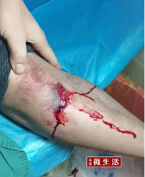 【祸从天降】永清一男子夜晚遇祸事,腿上好多血……_腾讯新闻