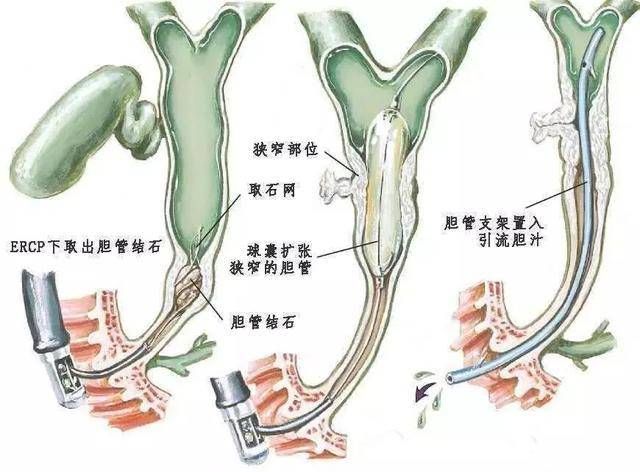 胆管支架手术过程图片图片