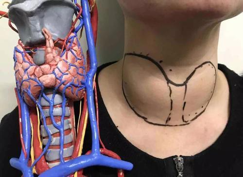 就是自己攻击自己,自身免疫功能增强,原本不应该在甲状腺组织中的淋巴