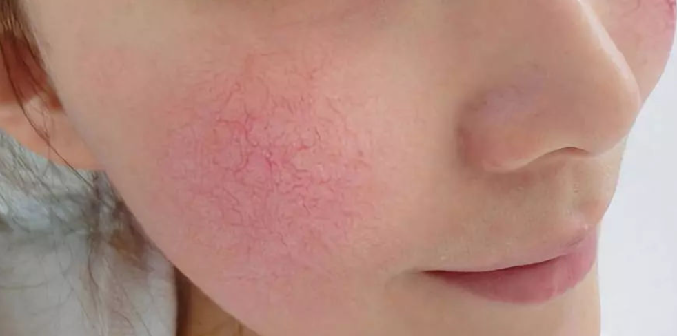 女人护肤时,皮肤"刺痛"千万不能忍!教你几招避免皮肤问题恶化