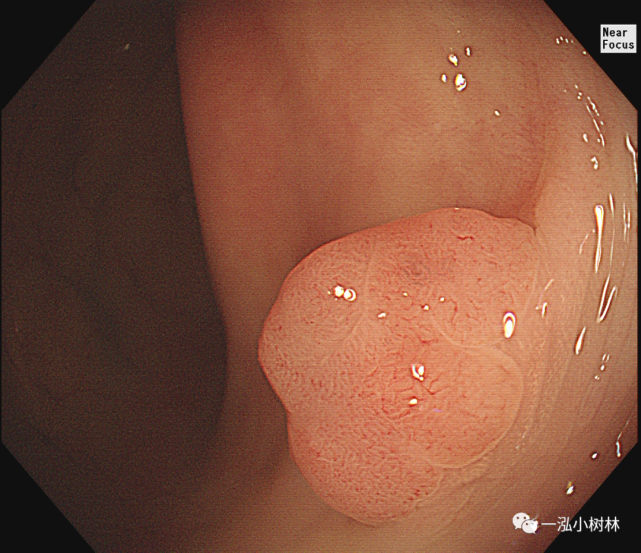 医生提醒这4种肠息肉会癌变