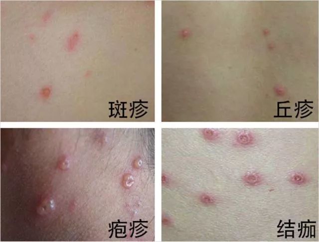 过敏性皮肤病的治疗∽中医治本谈临床