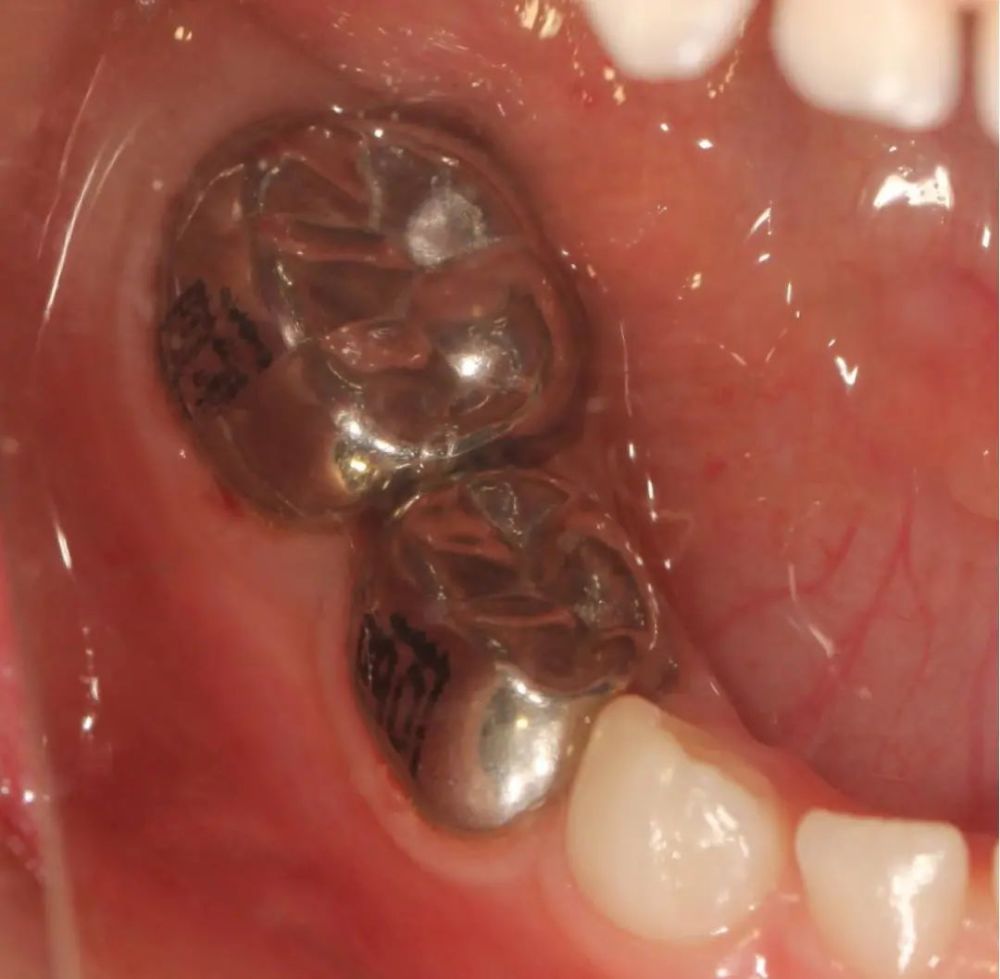 儿童乳牙预成冠到底有没有必要做呢?_腾讯新闻