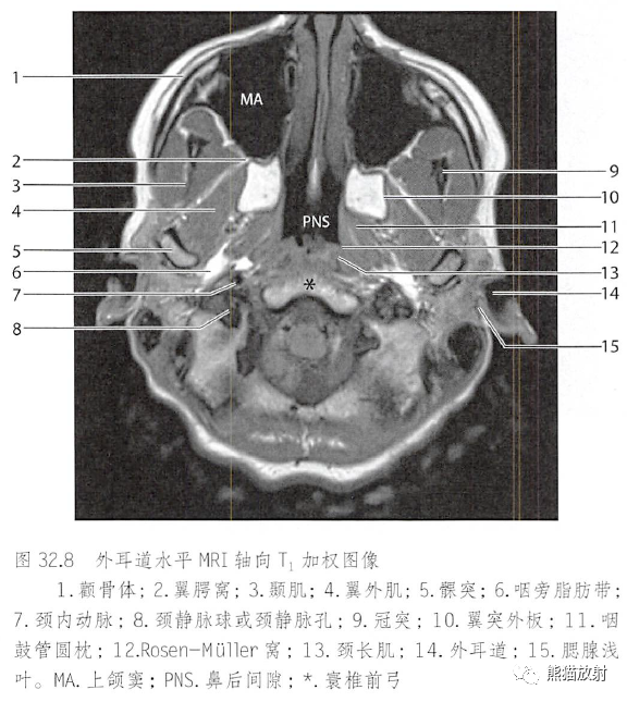 位置关系的变化咬肌和颞肌翼腭窝上颌神经与下颌神经翼管神经与翼腭