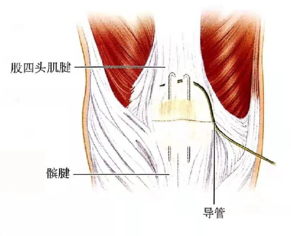 【骨科小技巧】髕骨骨折手術技巧!_騰訊新聞