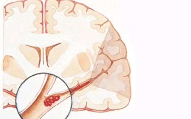 腔梗到底是个什么梗张医生教你如何预防