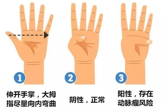 若大拇指轻松越过手掌边缘(如下图),为阳性,提示很可能患有主动脉瘤.