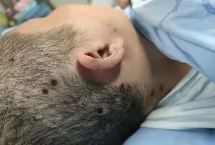 头部被马蜂蛰伤47处命悬一线成医附院医生为她两次换血救命