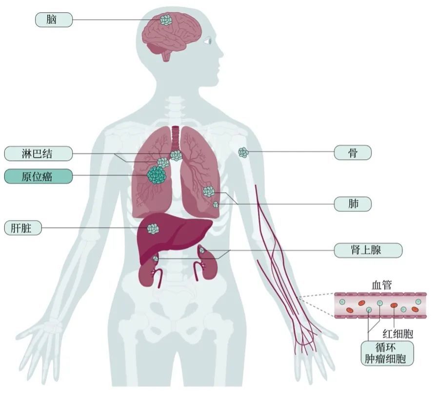 小细胞肺癌的常见转移部位小细胞肺癌除了容易发生全身转移,手术治疗