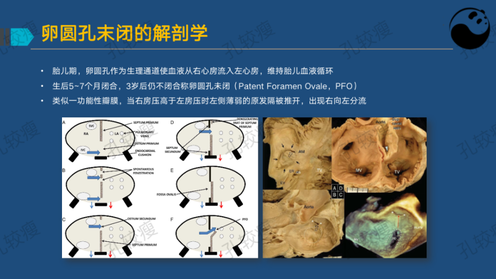 孔较瘦卵圆孔未闭的超声心动图评估