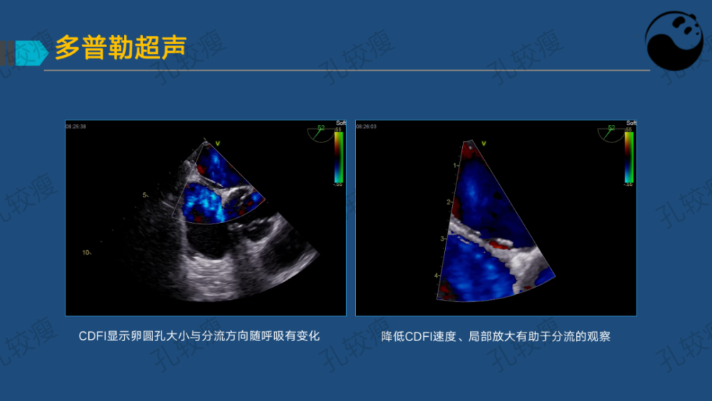 孔较瘦卵圆孔未闭的超声心动图评估