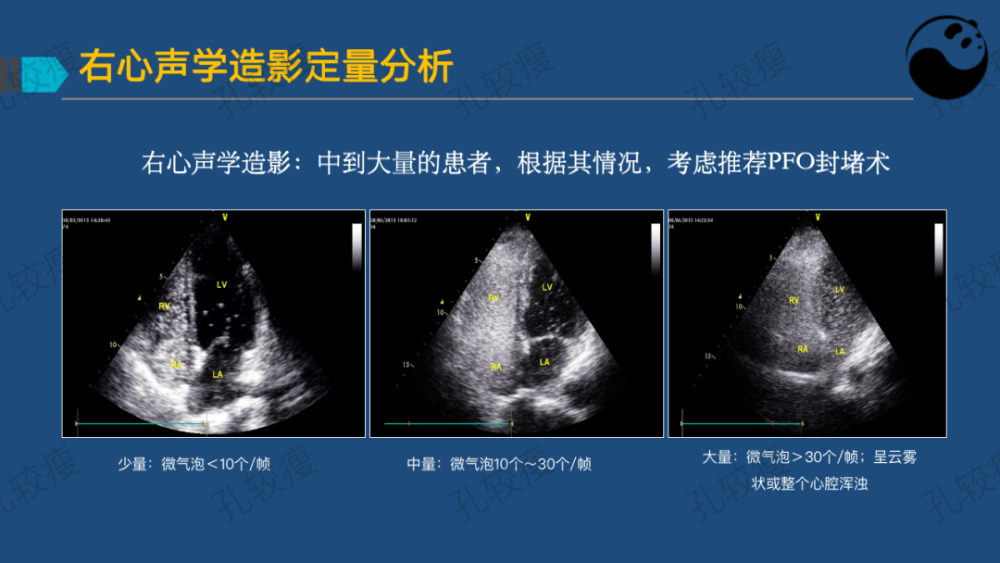 孔较瘦卵圆孔未闭的超声心动图评估