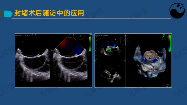 孔较瘦:卵圆孔未闭的超声心动图评估