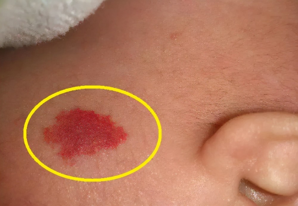 准妈妈吃酱油是宝宝有胎记的元凶别乱想真正的原因有3点