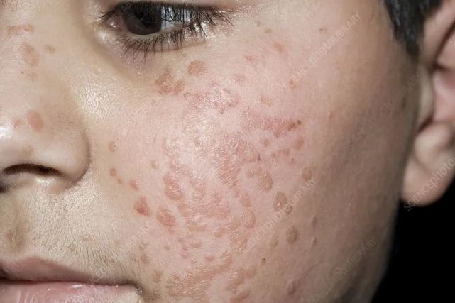 身上这4种肉疙瘩,可能和hpv感染有关_腾讯新闻