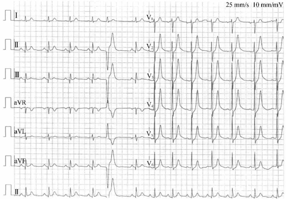 心电图t波异常图片