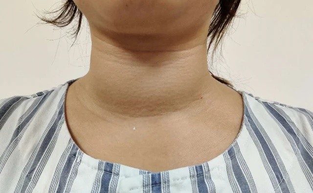 脖子变粗 腾讯网