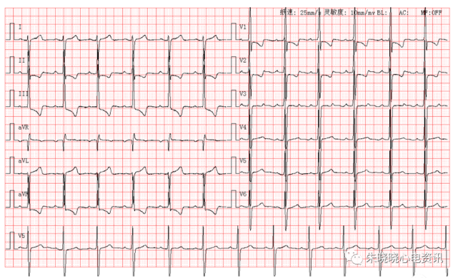 每日读图|第1562期 右心室高电压