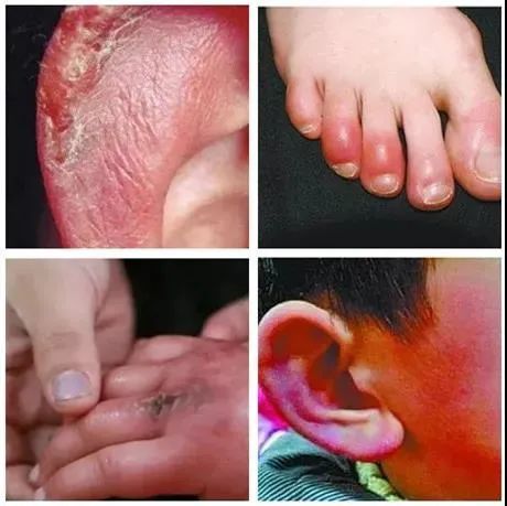 还有家里的小孩子也是娇嫩的小手,脸蛋,耳朵都被冻得满是冻疮红肿得又