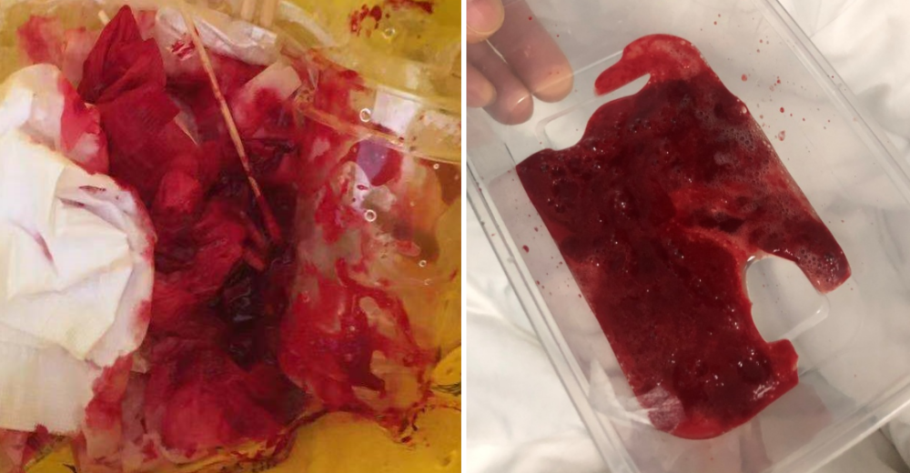 该患儿按以上标准为大咯血.