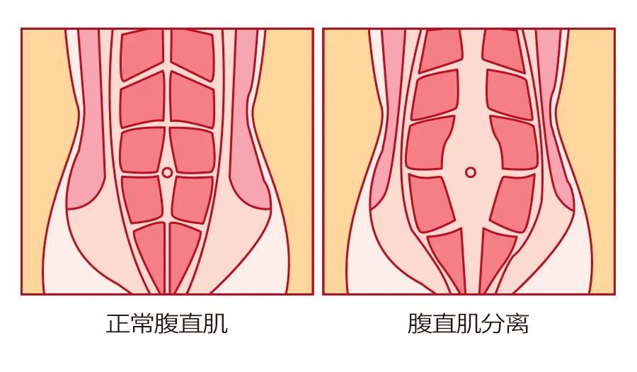 拿腹直肌分离来说,盲目的卷腹运动不仅不会瘦肚子,反而可能会加重腹直