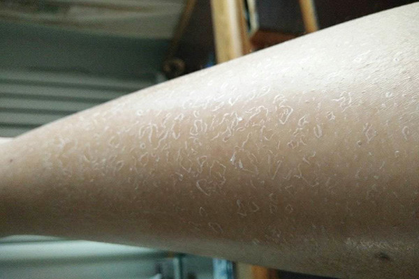 为什么一到秋冬腿上就掉白色皮屑教你改善白色皮屑小妙招