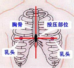 心肺復甦壓斷12根肋骨咋回事