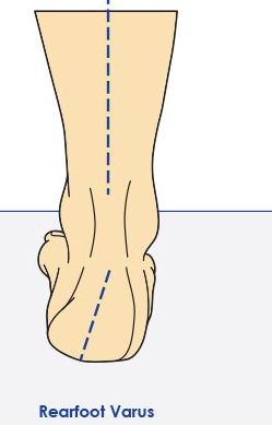 腿为什么又弯又粗看一眼脚底就知道