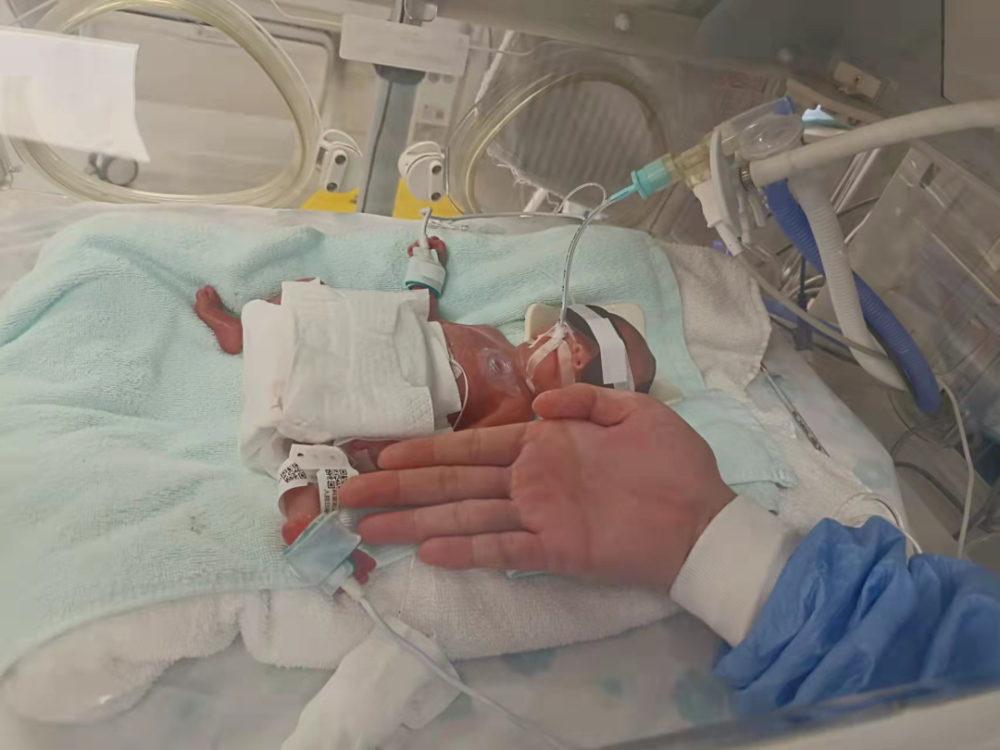 的阿不"巴掌宝宝"87天勇敢闯关"胎龄未满28周的宝宝又称为超早产宝宝