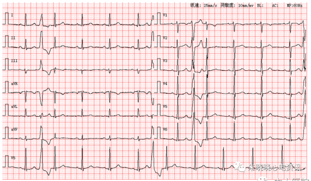 每日读图第1562期右心室高电压