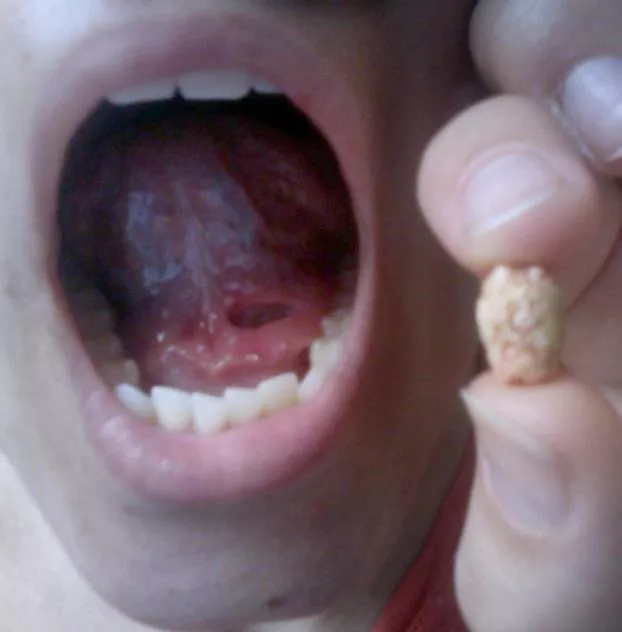 唾液腺堵塞症状照片图片