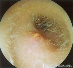 重庆弘医堂医院分享:中耳炎给患者带来的危害有哪些