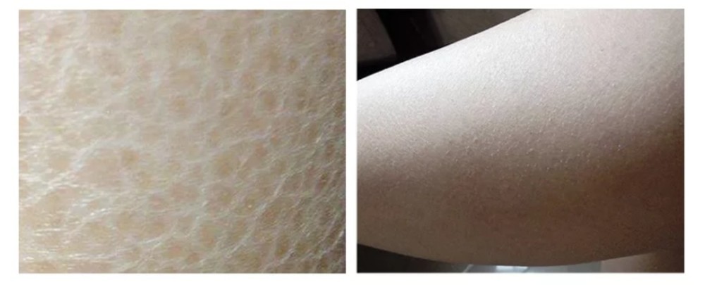 作为一名干皮星人,以前一到冬天,腿上的皮屑就像雪花一样往下掉,超