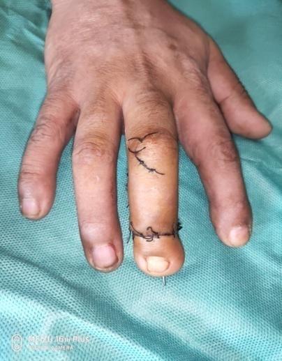 男子手指被割断,辗转2个月求医,手足显微团队移花接木,脚趾变拇指