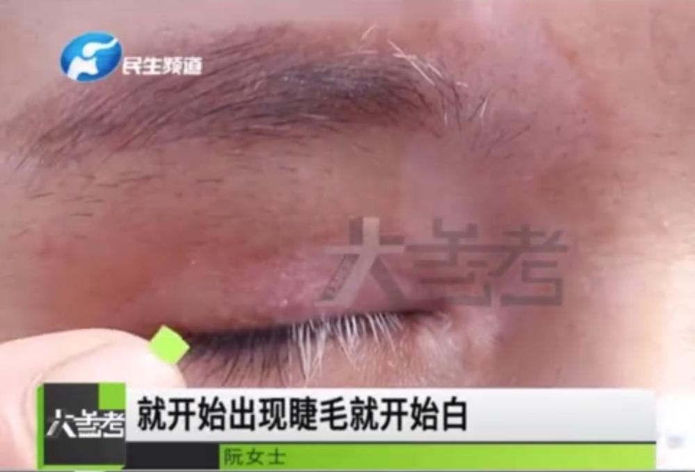 女子割双眼皮后变白眉大侠怀疑手术引起白癜风