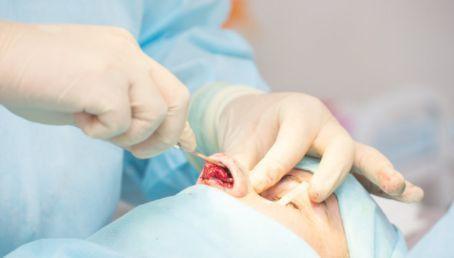 鼻腔|鼻塞|鼻炎|手术