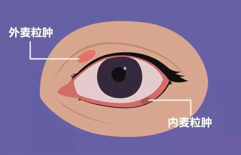 3岁孩子两个眼皮麦粒肿反反复复不见好中医辩证原因家长赞不绝口