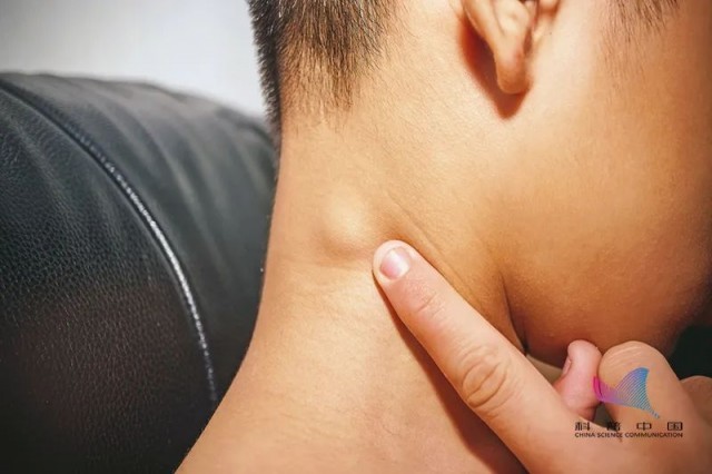 淋巴结肿大可能疼比不疼好这些部位摸一摸可自查