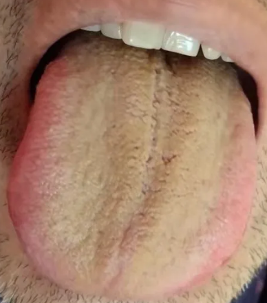 舌两侧偏红,为肝阴不足,一般有眼干或者肝阳上亢导致的头晕心悸血压高