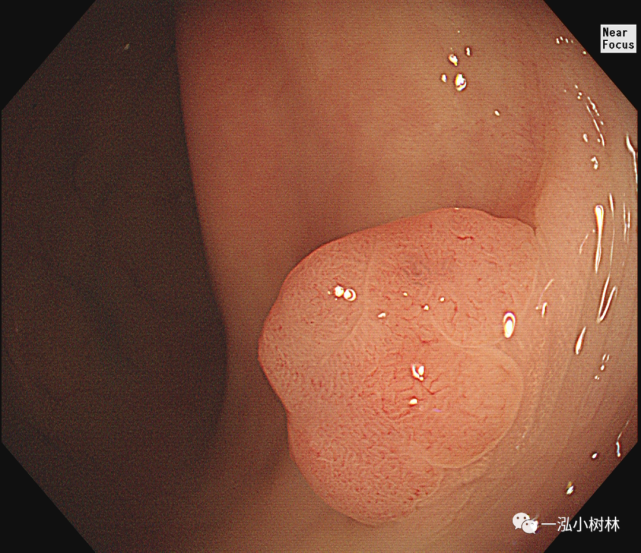 由于有较高的癌变几率,因此又称为肿瘤性息肉