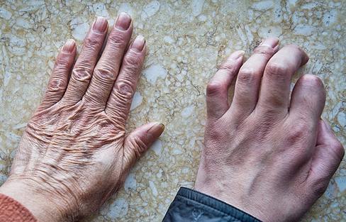 肌肉萎缩的症状表现有哪些广州和谐医院神经修复医学中心为您科普