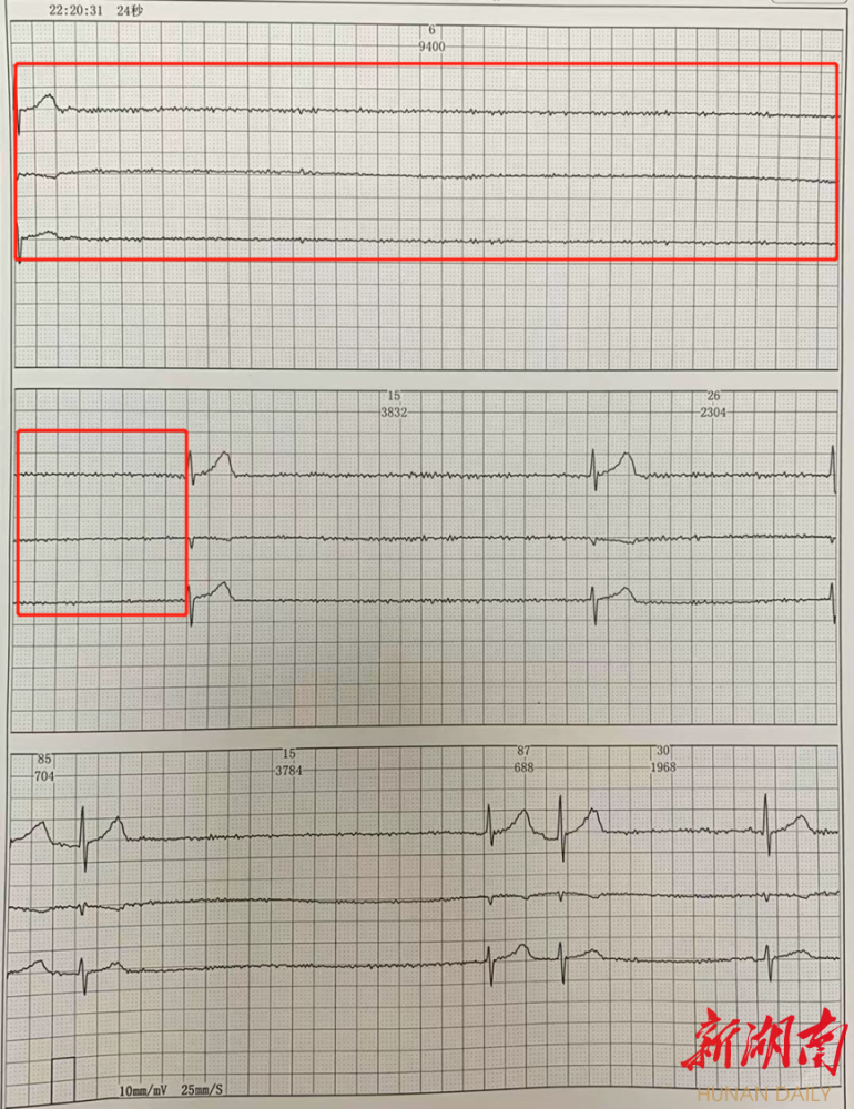 7旬奶奶常头晕竟是病态窦房结综合征引起