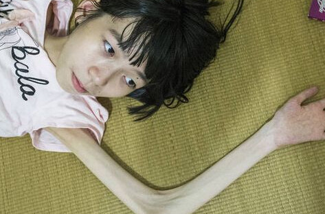 在众多神经系统疾病当中,肌肉萎缩的知名度远远落后于脊髓损伤,神经