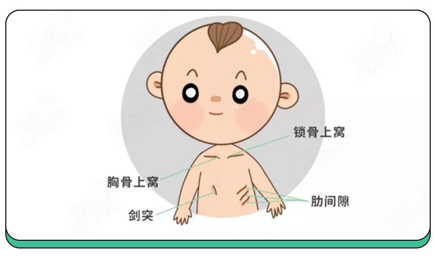 看肋胸骨,肋间隙凹的比较明显,有可能是肺炎.